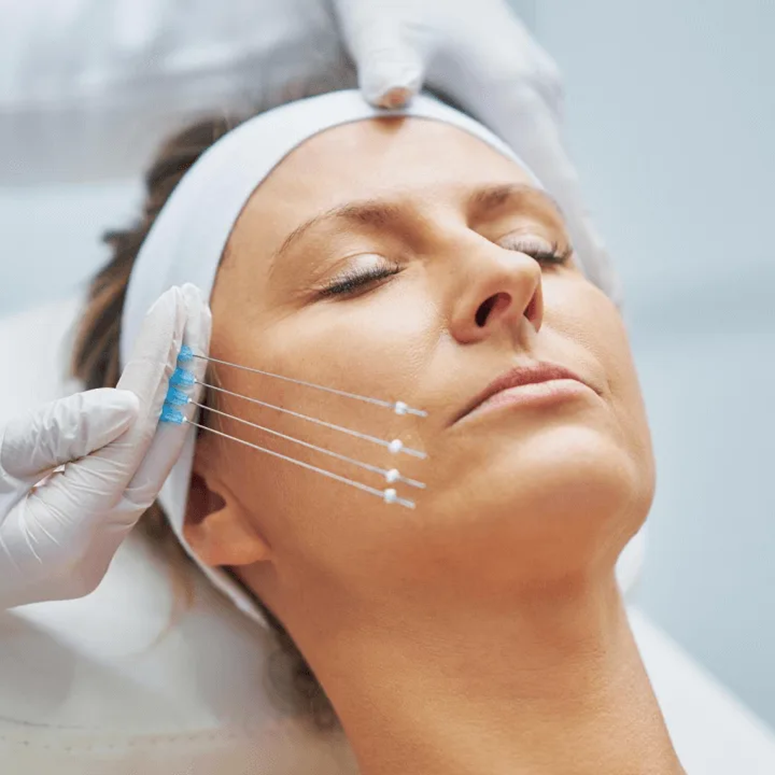 Нитевой лифтинг лица: что нужно знать и технология выполнения