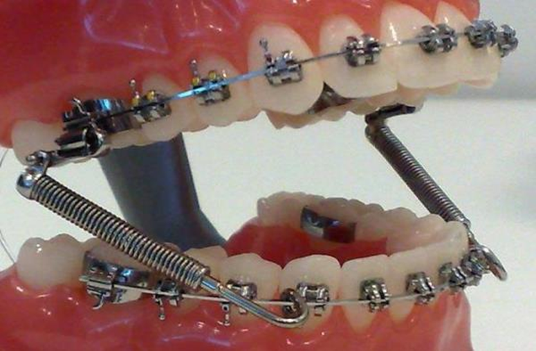 Преимущества и процесс установки брекетов для исправления прикуса